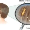 Doctors Will not Tell You this- Cheap Way to Get Rid of Lice Instantly