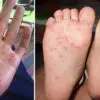 Hand-Foot-and-Mouth Disease on the Rise: Experts Beg Parents to Learn the Warning Signs