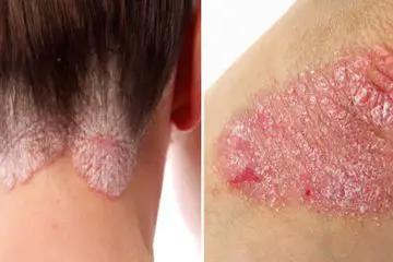 How to Detoxify & Get Rid of Psoriasis once & for All