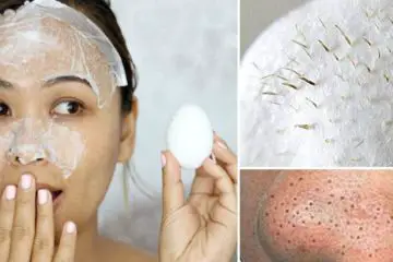 Natural Remedy for Removing Blackheads, Acne & Facial Hair without Pain