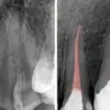 This Dentist Refused to Perform a Root Canal for over 20 Years- This Is Why