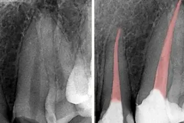 This Dentist Refused to Perform a Root Canal for over 20 Years- This Is Why