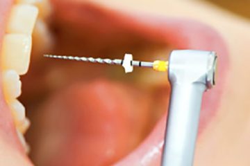 Toxic Teeth: How Root Canal Procedure Increases the Risk of Chronic Disease