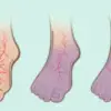 If You Have Poor Circulation, Cold Feet or Varicose Veins, Start Doing these 6 Things