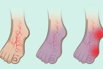 If You Have Poor Circulation, Cold Feet or Varicose Veins, Start Doing these 6 Things