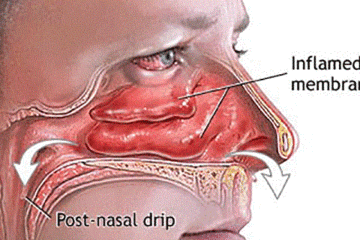 How to Clear Your Sinuses in Seconds Using only Your Fingers