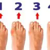 Bunions: What They Are & How to Treat Them