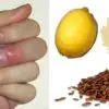 5 Effective & Easy Ways to Treat Finger & Toe Whitlow