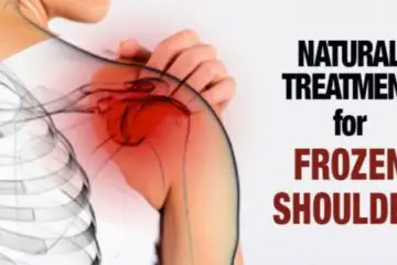 Frozen Shoulder: Natural Treatment to Heal it within Days