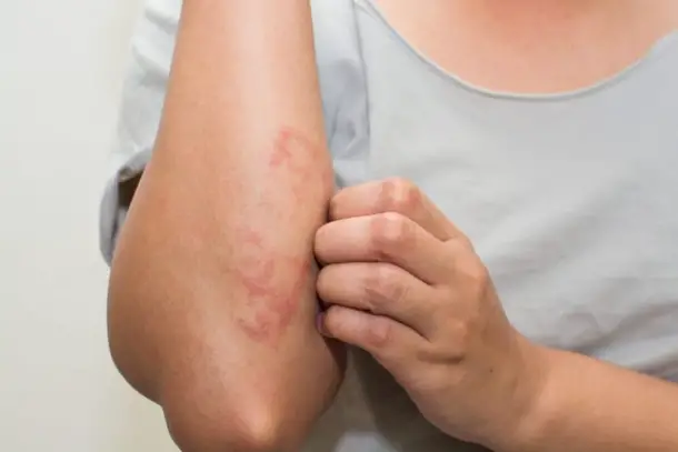 7 Major Eczema Causes that Doctors never Treat