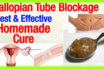 Natural Treatment for Blocked Fallopian Tubes