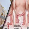 Remove Pounds of Toxins from the Intestines with these 2 Ingredients