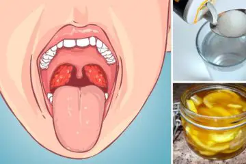 Caught a Strep Throat Infection? Try Out these 5 Natural DIY Remedies