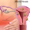 5 Warning Uterine Fibroids Causes, Signs And Tips For How To Shrink Them Naturally