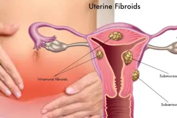 5 Warning Uterine Fibroids Causes, Signs And Tips For How To Shrink Them Naturally