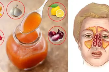 The Best DIY Remedy for Sinus Infection: 5 Simple Ingredients Only