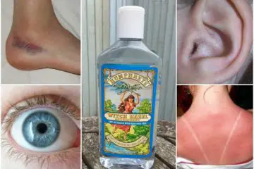 10 Surprising Uses for Witch Hazel You never Thought of