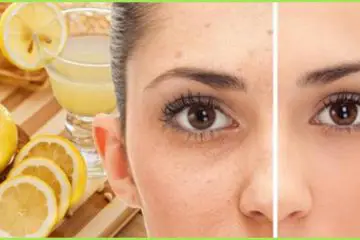 Remove Freckles & Brown Spots with this Amazing DIY All-Natural Remedy