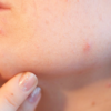 Your Acne Reveals Important Information about Your Health