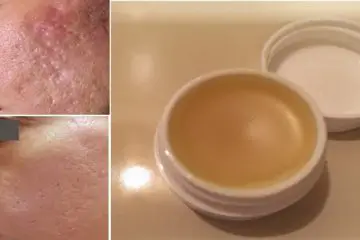Unique DIY Scar Removal Cream: Removes Scars Long-Term within 2 Weeks