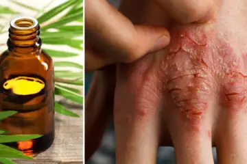 All-Natural DIY Eczema Cream Made from Essential Oils
