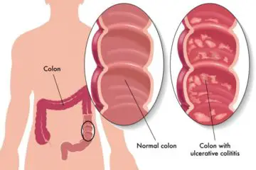 Early Cancer Detection Saves Lives: the 5 Major Symptoms of Colon Cancer