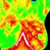 Thermography Is Not a Better Substitute for Mammogram as First Thought