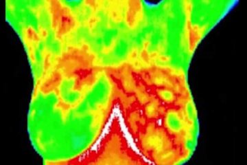 Thermography Is Not a Better Substitute for Mammogram as First Thought