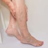 Chronic Venous Insufficiency Triggers Leg Ache; 5 Natural Ways to Relieve the Symptoms
