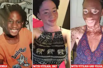 25-Year-Old Vitiligo Sufferer Claims Veganism Helped Her Reverse the Condition