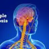 Alleviate Multiple Sclerosis Symptoms with these 5 Natural Remedies