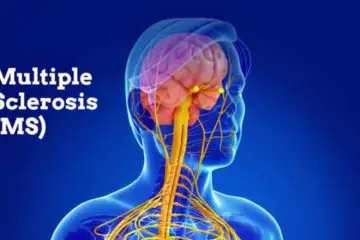 Alleviate Multiple Sclerosis Symptoms with these 5 Natural Remedies