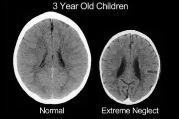 Brain Scan Shows the Terrible Damage on Kids Who’re Emotionally Abused