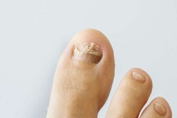 Gross Video Showing what Happens when Fungal Toenail Infection Is Untreated for a Year