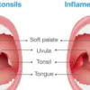 Alleviate Tonsillitis with these 5 Simple & Effective Natural Remedies