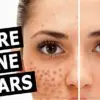 10 Beneficial Methods to Relieve Acne Scars