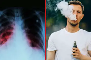 CDC Warns against Vaping after Spike in Lung Disease