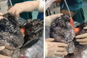 Shocking Images Show the Black Lungs of 52-Year-Old Smoker Who Smoked a Pack Daily for 30 Years