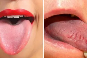 7 Things Your Tongue Is Trying to Tell You about Your Health