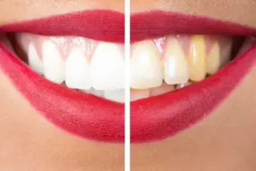 Say Goodbye to Yellow Teeth with these 5 Natural Whiteners