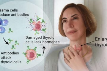 Great Natural Remedies to Alleviate Hashimoto’s Thyroiditis