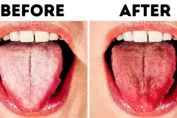 10 Natural Ways to Get Rid of White Tongue