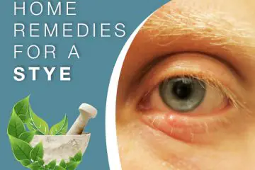 How to Get Rid of a Stye Naturally