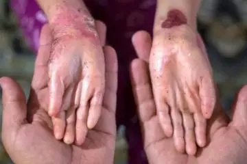 Innovative Gene-Therapy Gel Promising for Blistering Skin Disease (Cure for ‘Butterfly Children’?)