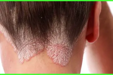 5 Helpful Home Remedies to Relieve Scalp Ringworm