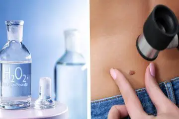 How to Use Hydrogen Peroxide & Remove Skin Tags at Home