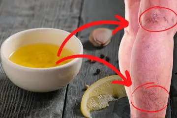 DIY Powerful & Healing Garlic & Lemon Ointment for Varicose Veins