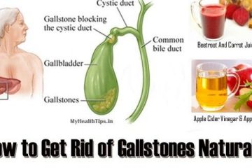 Natural & Effective: The Best Home Remedies for Gallstones