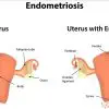 Alleviate the Symptoms of Endometriosis with these Powerful Home Remedies