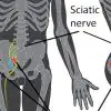 5 Tell-Tale Signs of Sciatica You Should Never Overlook